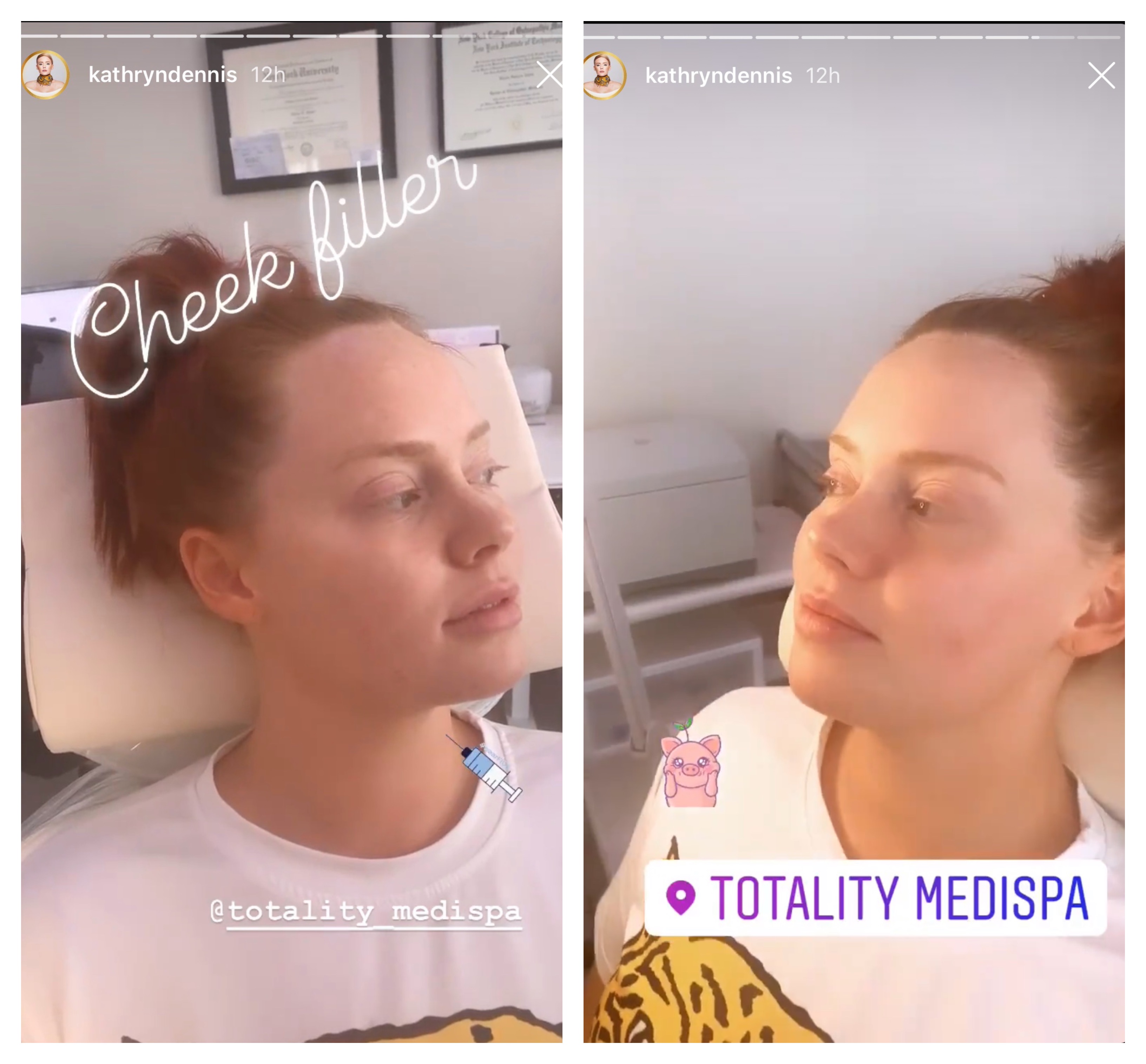 Kathryn Dennis Gets Fillers During Coronavirus Pandemic