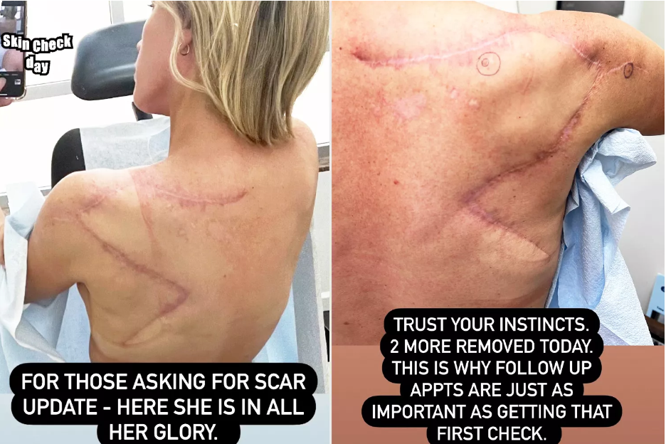 Teddi Mellencamp reveals scars from melanoma removal.